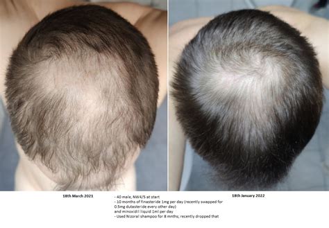 reddit tressless|female hair loss treatment reddit.